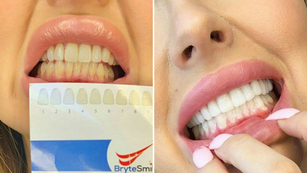 How to make your teeth whiter in 3 minutes at home?